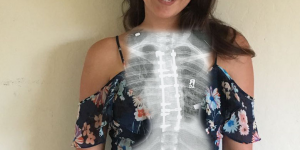 Photo submitted by Emily Hurry - Depicts a person wearing a floral print dress with an x-ray of a spine superimposed over their body. The spine in the x-ray has a curve and metal bolts/pins attached to it.