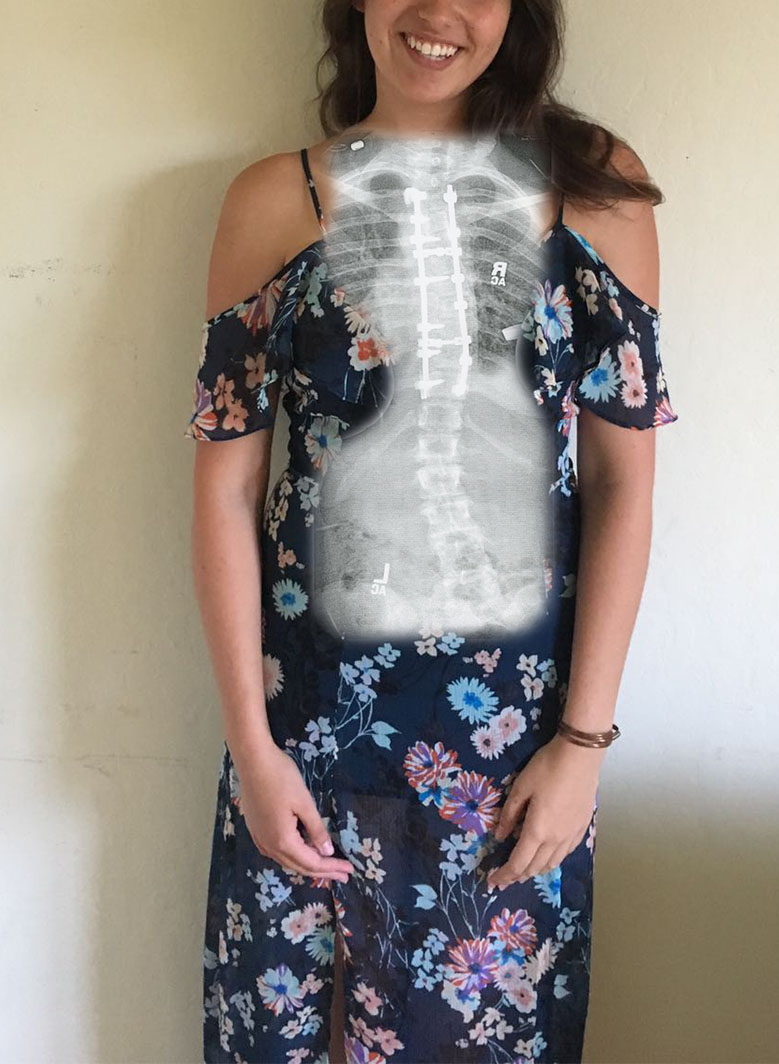 Photo submitted by Emily Hurry - Depicts a person wearing a floral print dress with an x-ray of a spine superimposed over their body. The spine in the x-ray has a curve and metal bolts/pins attached to it.